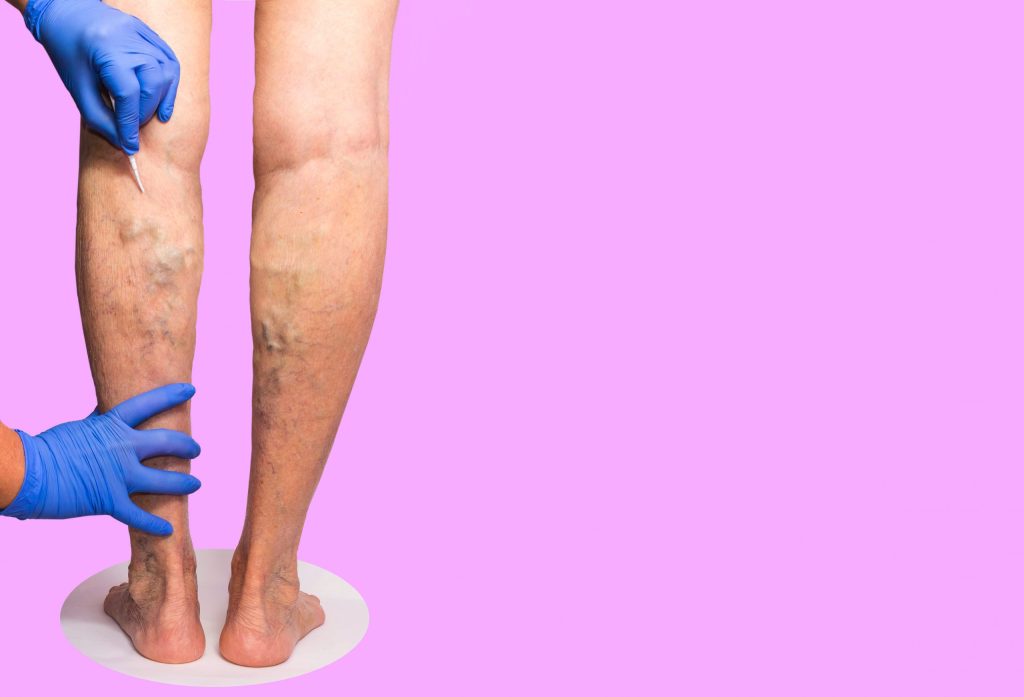 Are Varicose Vein Treatments Covered by Insurance
