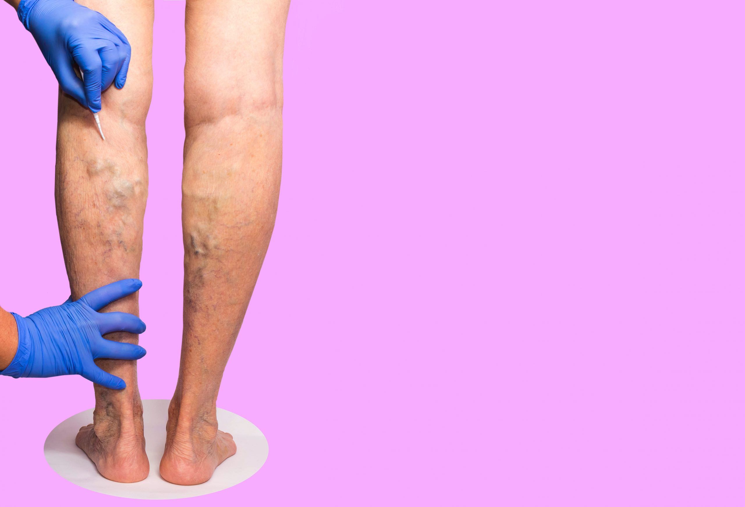 Are Varicose Vein Treatments Covered By Insurance? What Type Of Doctor Treats Varicose Veins?