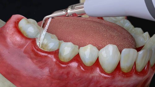 Effective Gingivitis Treatment And Bone Graft Dental Procedures