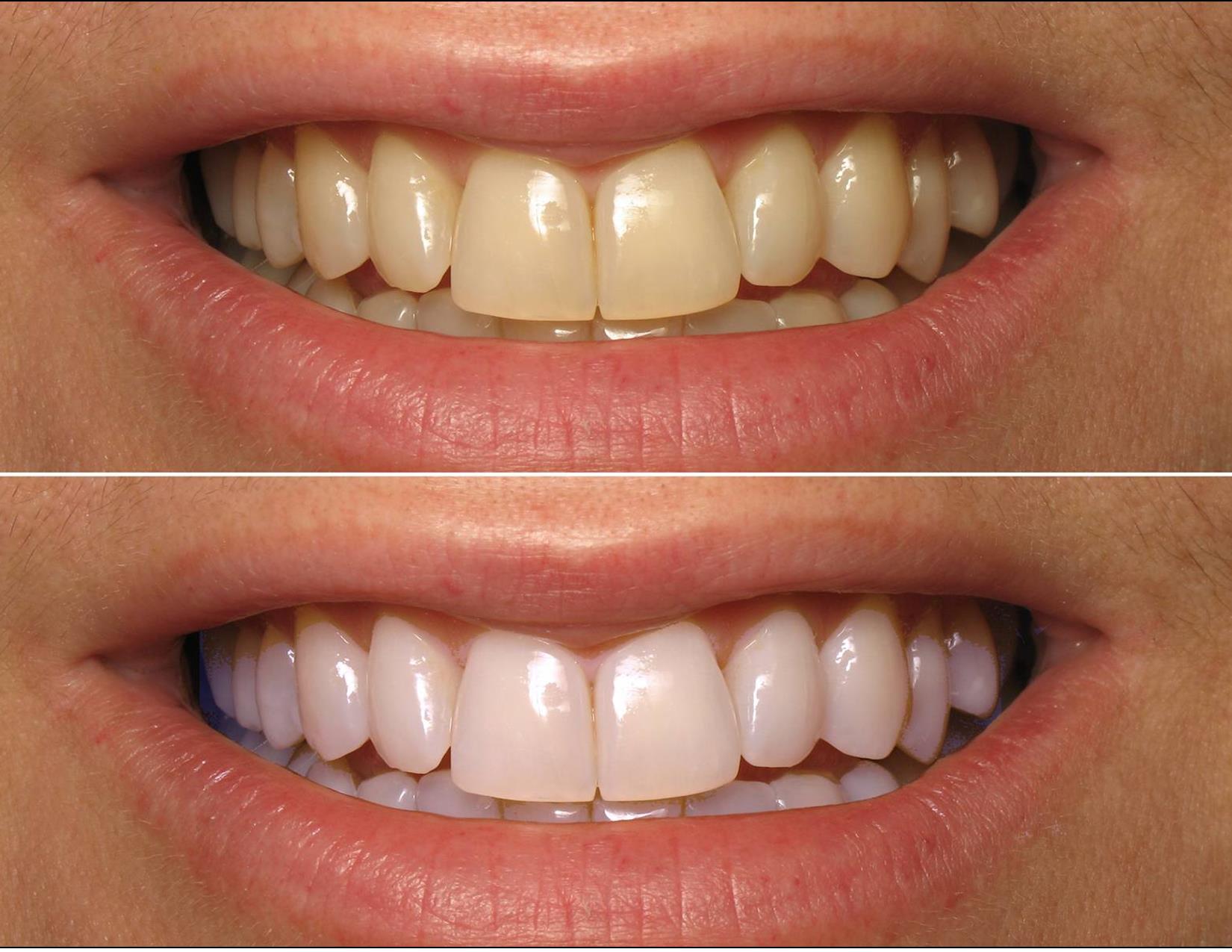 Achieving A Dazzling Smile: Laser Teeth Whitening Before And After