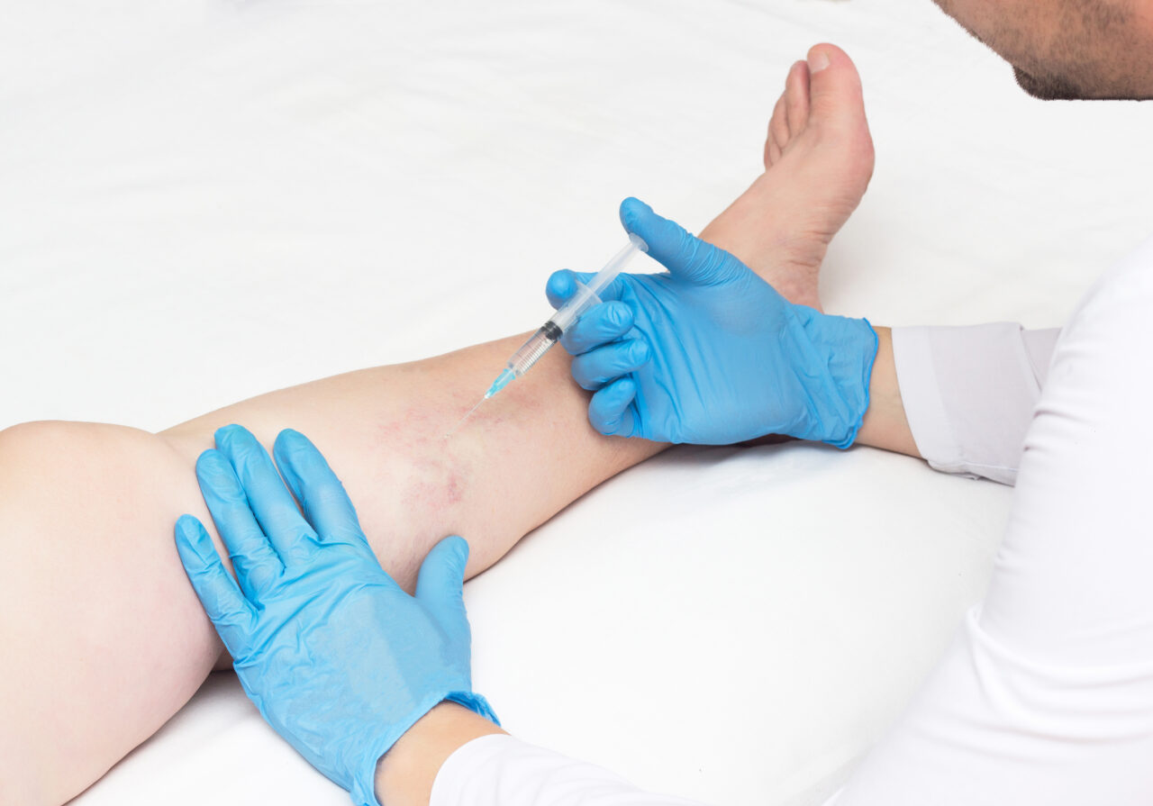 Are Varicose Veins Covered By Insurance? What Kind Of Doctor Treats Varicose Veins?