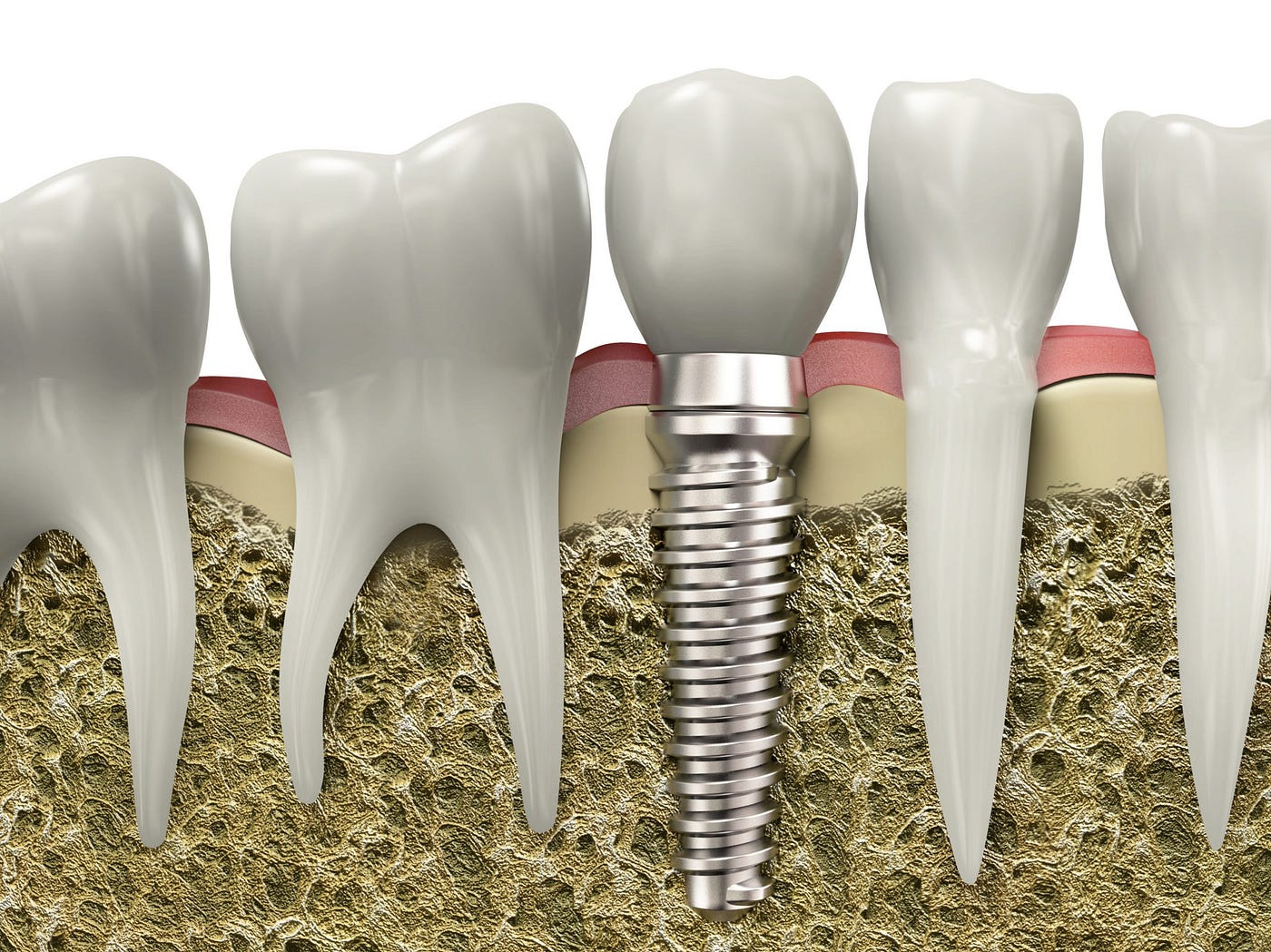 Can 6-Month Braces And Crown Lengthening Surgery Transform Your Smile In Record Time?