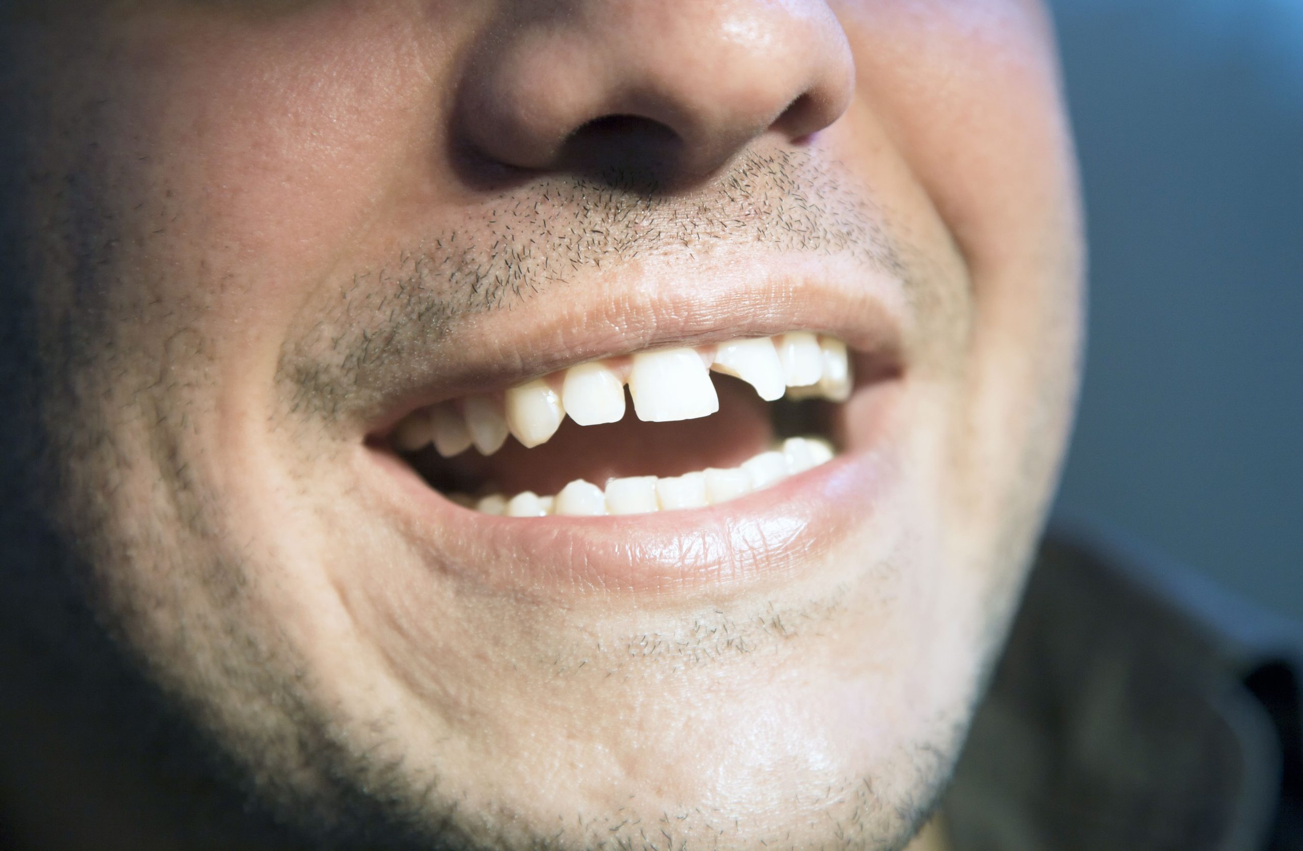 Is Wisdom Tooth Removal Affected By Metal Braces? A Comprehensive Guide?