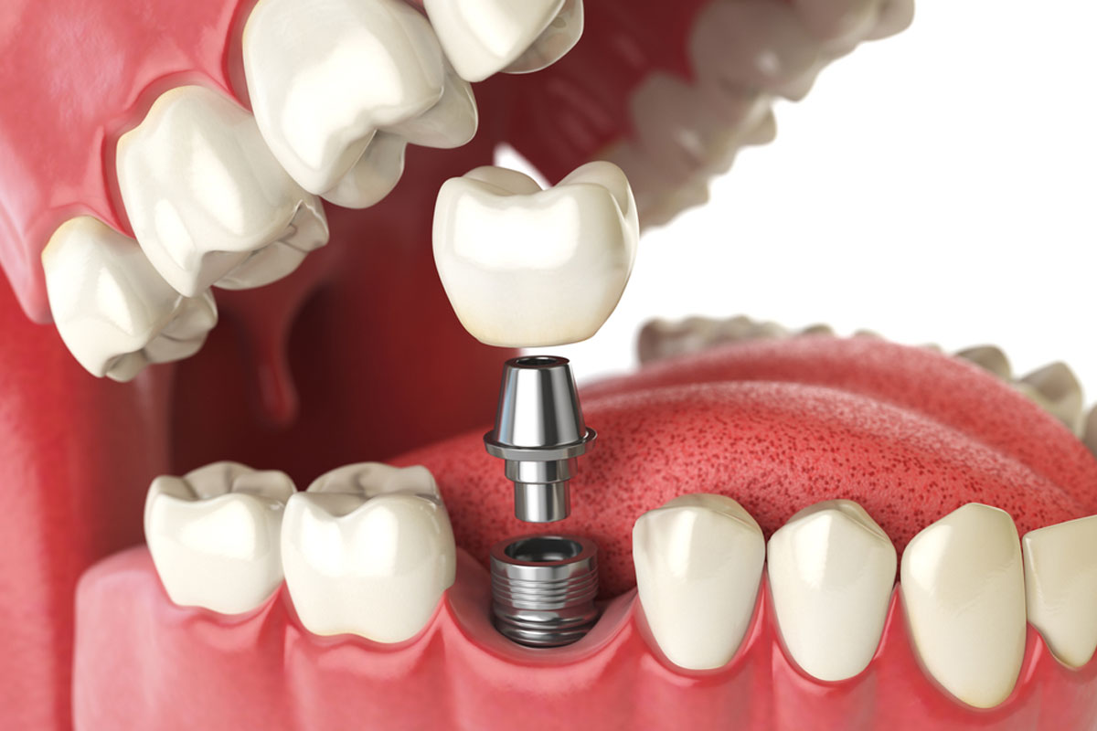 What Is Dental Numbering Chart: A Comprehensive Guide To Understanding Numbering Of TeethWhat Is Dental Numbering Chart: A Comprehensive Guide To Understanding Numbering Of Teeth