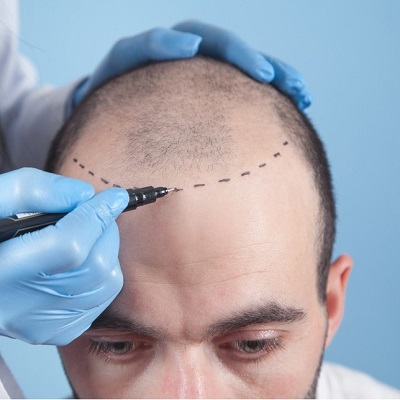 Best Hair Transplant Treatment in Islamabad