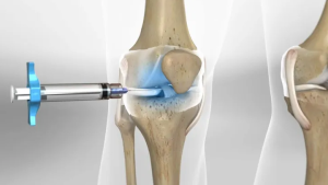 HYALURONIC ACID FOR KNEE PAIN