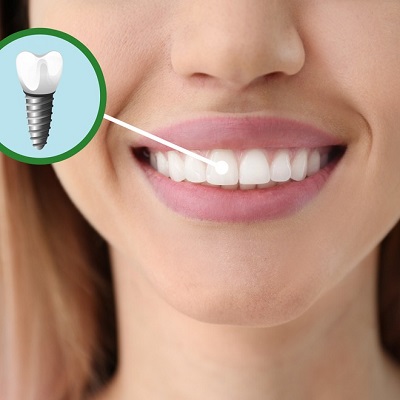 The Journey to Dental Implants: A Comprehensive Guide