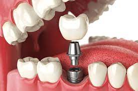 Dental Implant Aftercare Tips for Islamabad Residents